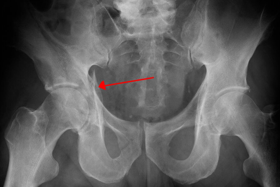 Best Tests To Predict Likelihood of a Fracture