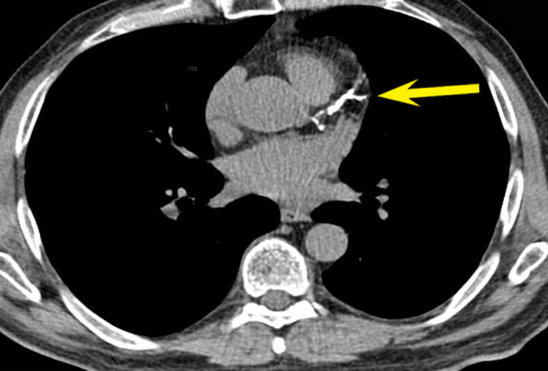 Calcium Heart Scan – Priceless